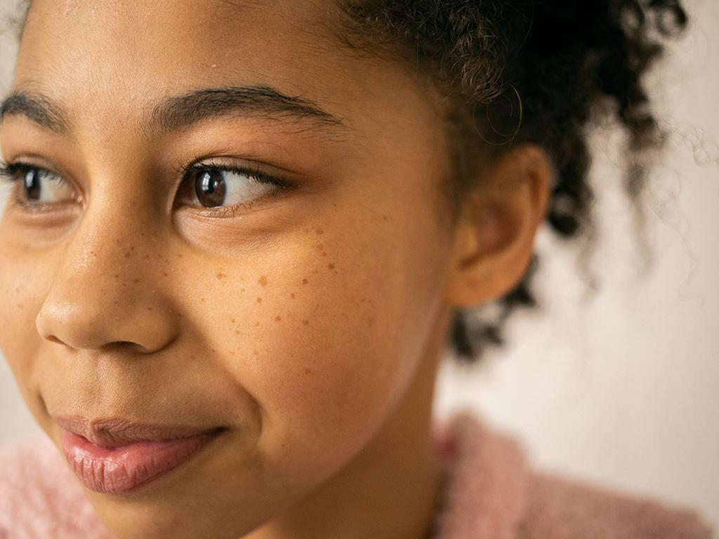 What Causes Seborrheic Dermatitis?