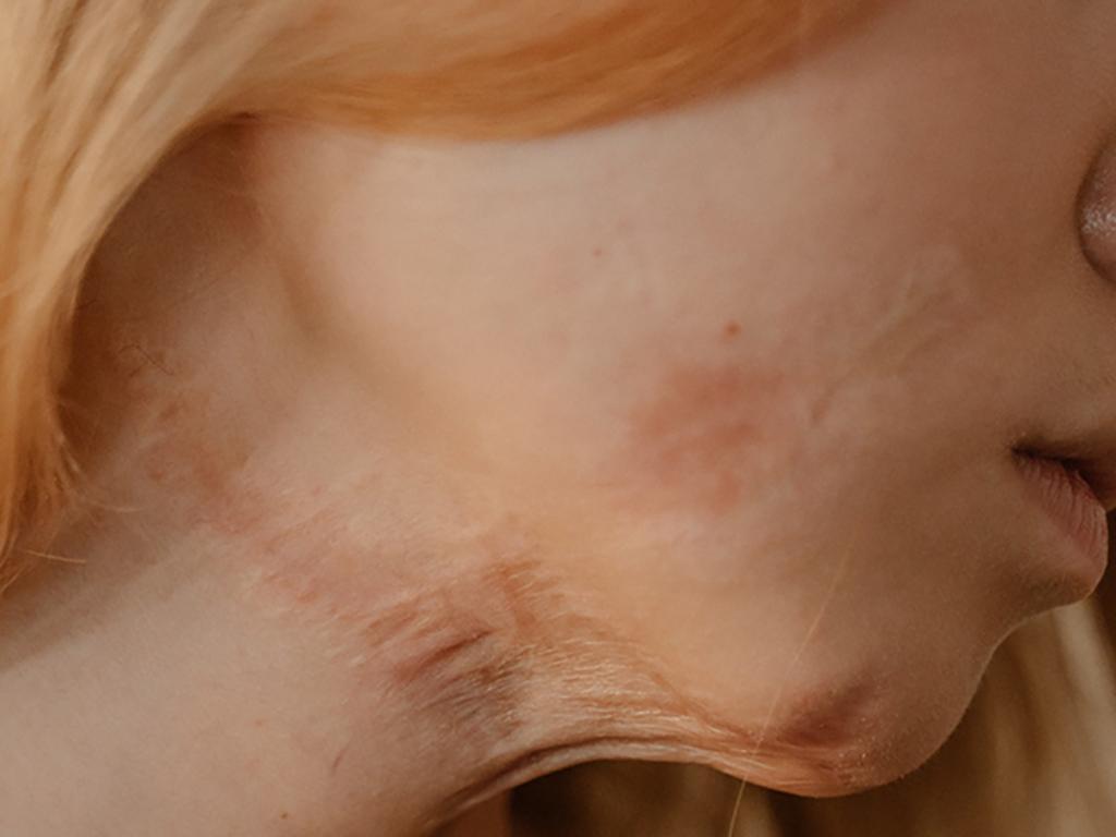 What causes pimples to grow on the corners of the mouth?