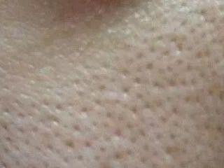 How to treat what seems to be seborrheic dermatitis or tinea capitis?