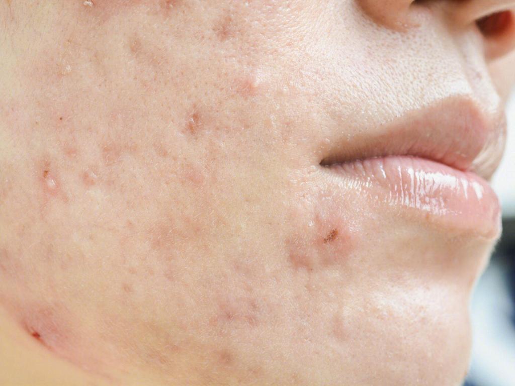 How to treat the pimples on the labia minora